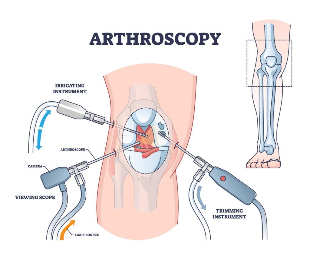 Arthroscopy: Complete Guide to Minimally Invasive Surgery