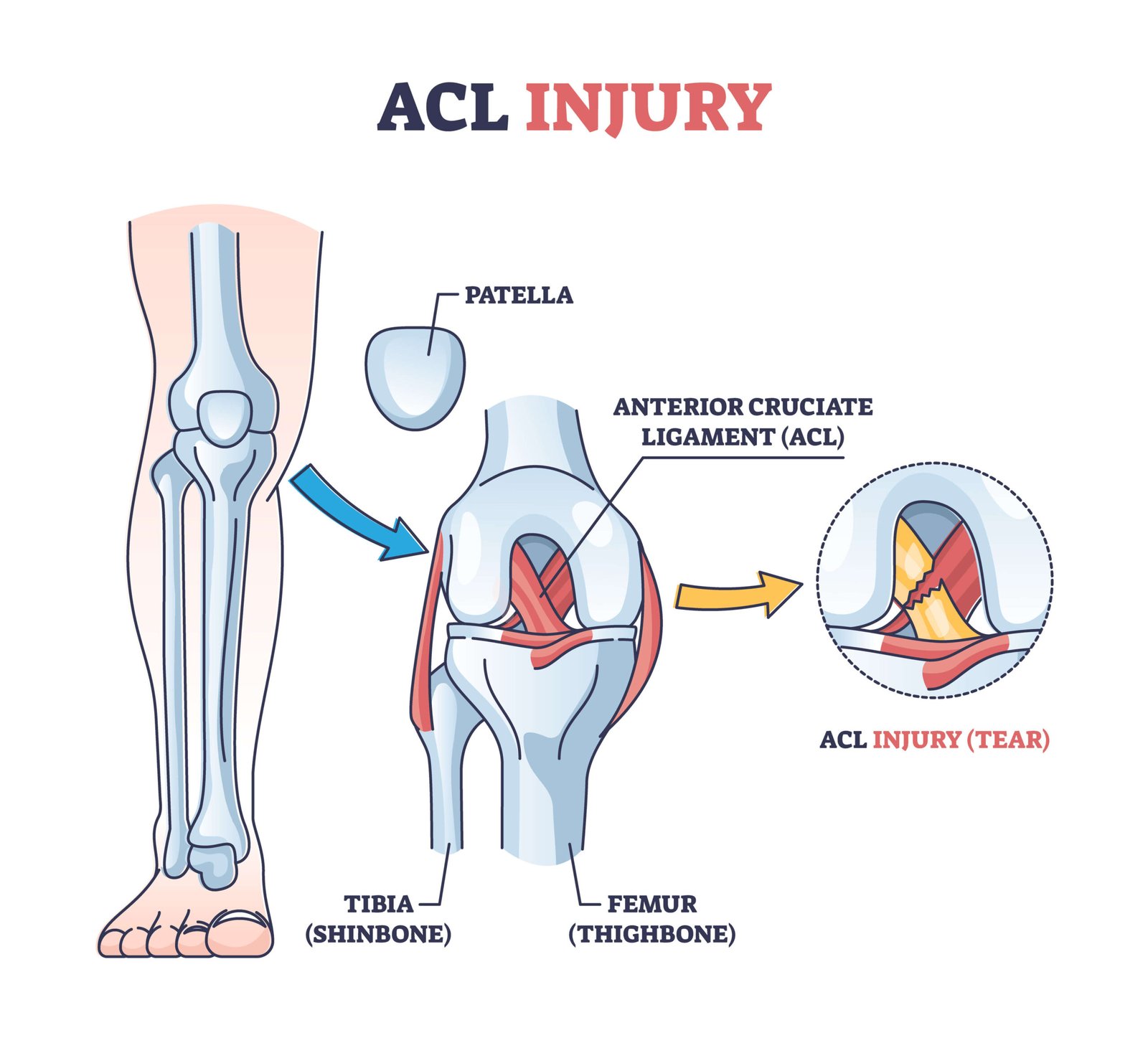 Anterior Cruciate Ligament Repair