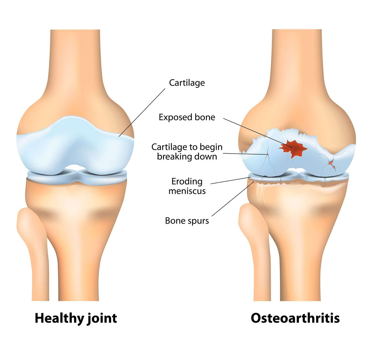 Total Knee Replacement Surgeon in Noida