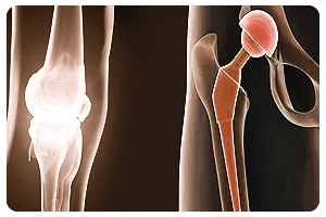 Dr Anuj Jain - Revision Joint Surgery