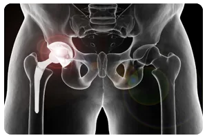 Dr Anuj Jain - Hip Replacement