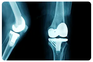 Dr Anuj Jain - Knee Replacement
